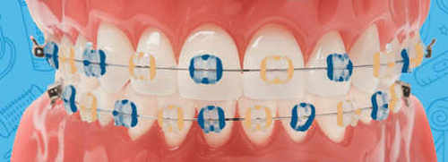 braces-msu-bobcats-colors